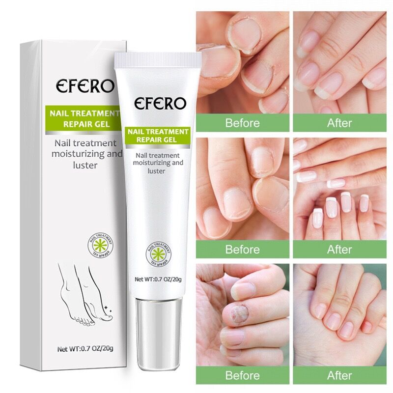 🎁BUY 1 GET 1 FREE🎁Anti-Fungal Gel