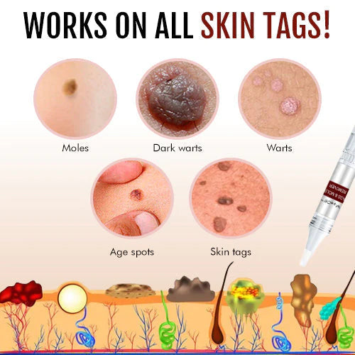 🎁BUY 1 GET 1 FREE🎁CC™ Tags & Moles Remover